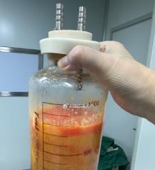 龙海水动力吸脂手术要做多久？